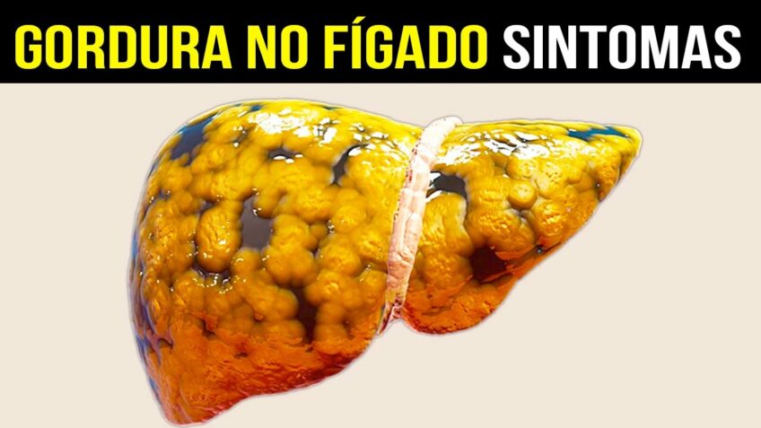 10 Sintomas de Gordura no Fígado [CUIDADO COM ESSES SINAIS]